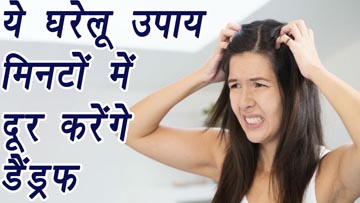 Home Remedies For Hair Dandruff In Hindi रूसी के लिए घरेलू ईलाज