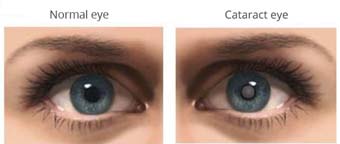 मोतियाबिंद क्या है What Is Cataract