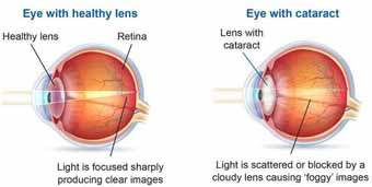 मोतियाबिंद के लक्षण और कारण Cataract Symptoms And Causes