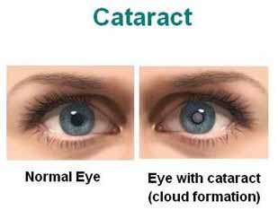 types causes and prevention of cataract